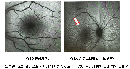 <정상안저사진>/ <점처럼 분포되어있는 드루젠>