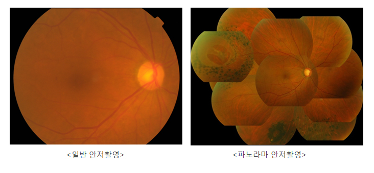 일반 안저촬영 / 파노라마 안저촬영