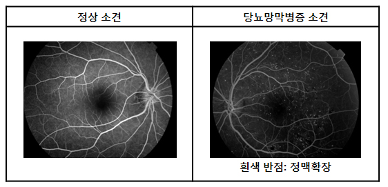 정상 소견 / 당뇨망막병증 소견(흰색 반점: 정맥확장)