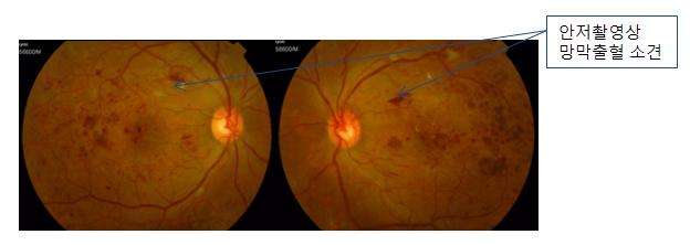 안저촬영상 망막출혈 소견