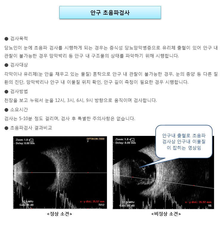 안구 초음파검사