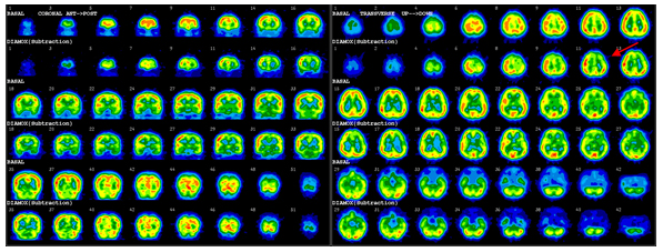 diamox 약물 투여 후 좌측 전두엽 피질의 activity가 중등도로 감소되어 혈관예비능이 감소된 것을 확인할 수 있는 영상 검사 사진 예시