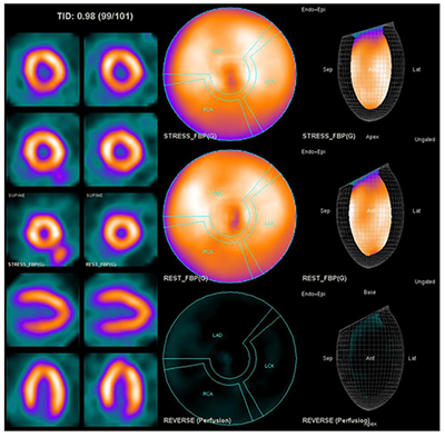 동위원소가 좌심실 전체에 고르게 분포합니다. 정상 소견이 보이는 영상 검사 사진 예시