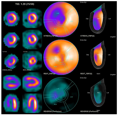 부하기 검사에서 좌심실 좌전 하행동맥 영역에 동위원소 섭취 감소가 관찰되나, 휴식기 검사에서 거의 회복되는 소견을 보이며, 부분적으로 가역적인 심근허혈이 있음을 보이는 영상 검사 사진 예시