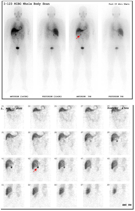 갈색세포증 환자의 123I ?MIBG 영상 사진 예시