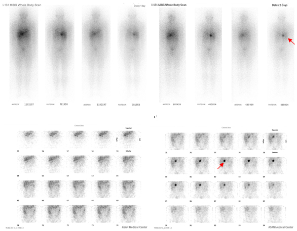 갈색세포종 환자의131I ?MIBG 스캔 영상 사진 예시