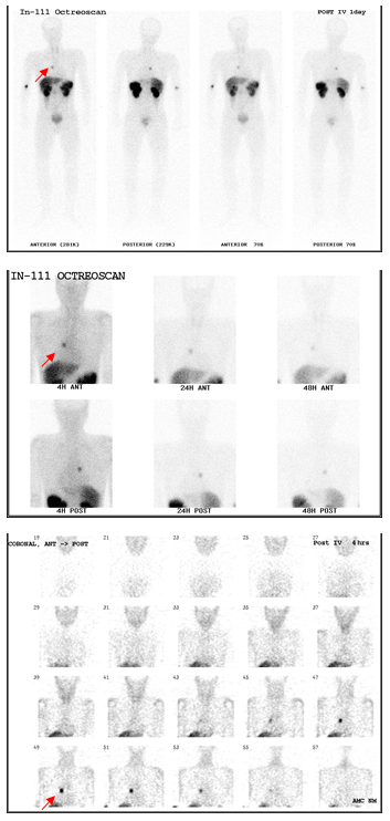 부신결정종 환자의 111in-Ooctreotide 스캔 영상 사진 예시