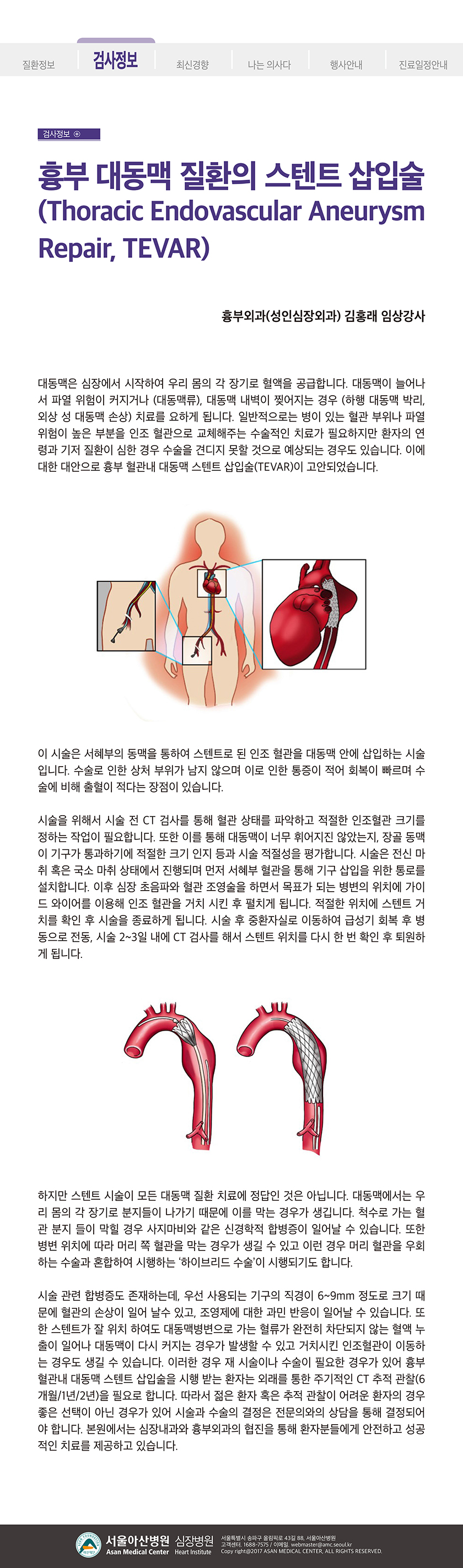 아산심장소식지 2021년 겨울호 흉부 대동맥 질환의 스텐트 삽입술 아산심장소식지 일반인정보 심장병원 서울아산병원 8603