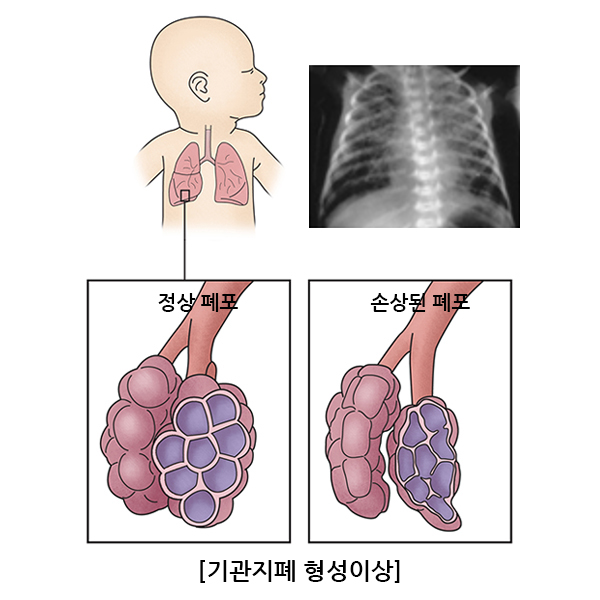 만성 호흡기 질환: 기관지폐형성이상 이미지