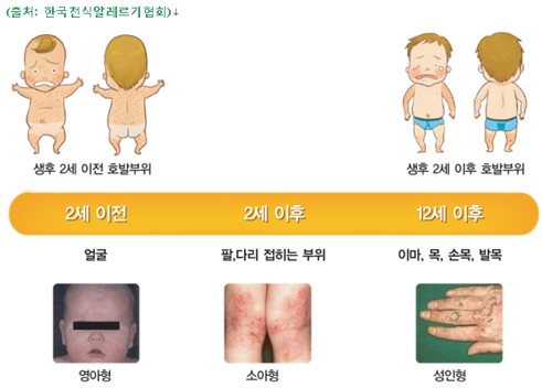 아토피피부염: 부위 이미지