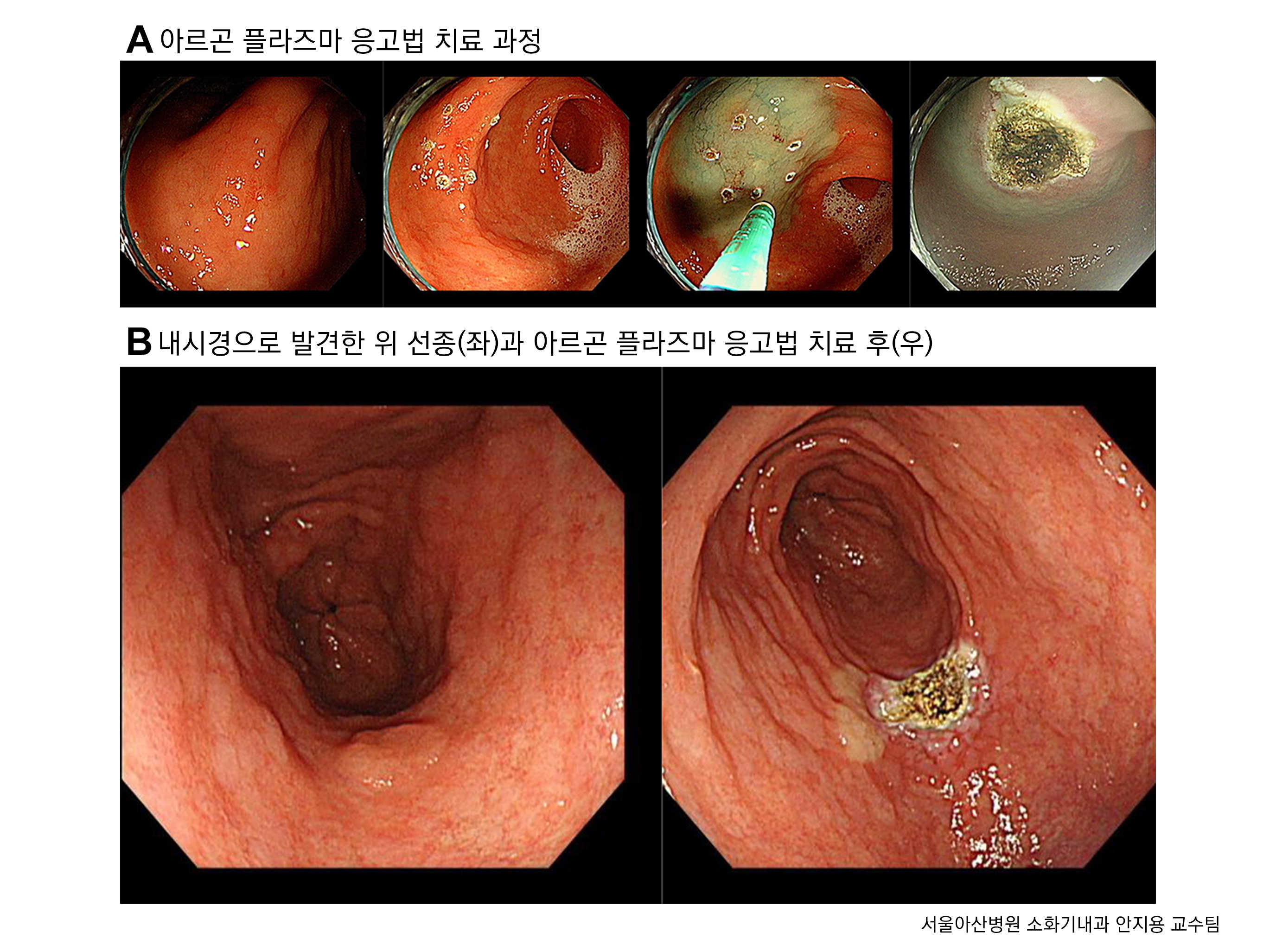 아르곤 플라즈마 응고법으로 위 선종을 치료하는 과정 이미지